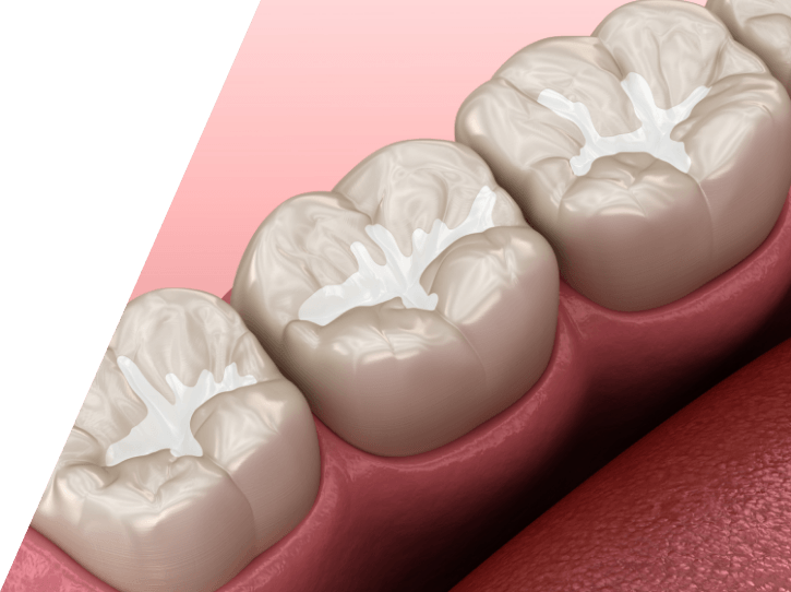 Animated smile during dental sealant placement