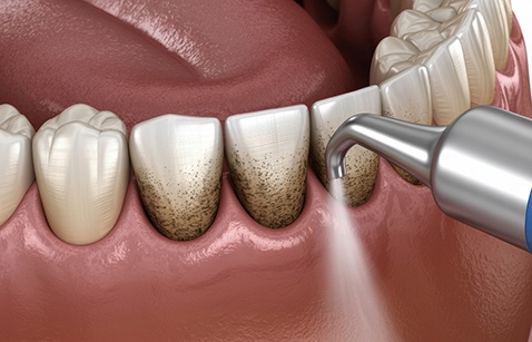Illustration of air polisher being used on teeth