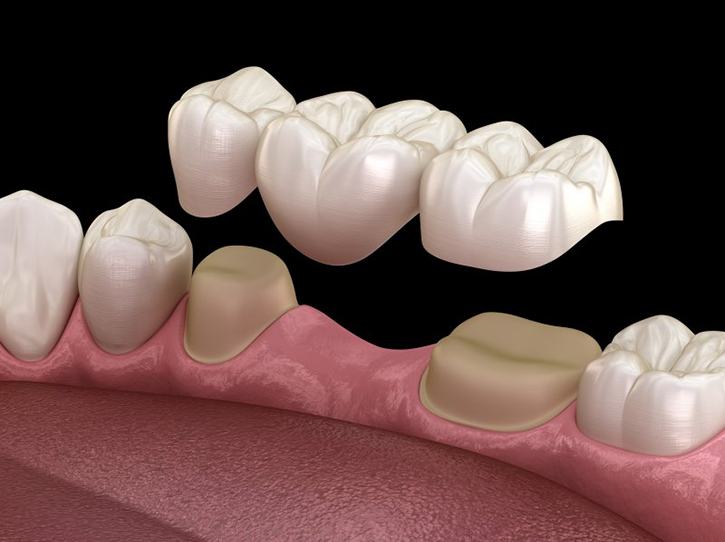 a 3 D illustration of a traditional dental bridge