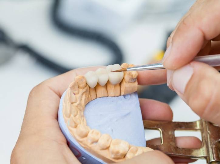 a mature woman smiling after getting dental bridges