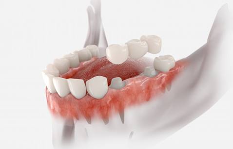 a dental technician working on creating a dental bridge