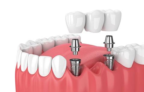 a 3 D illustration of a traditional dental bridge