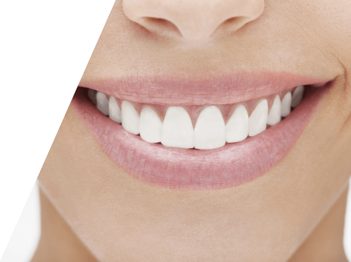 Closeup of flawless smile after virtual smile design treatment planning