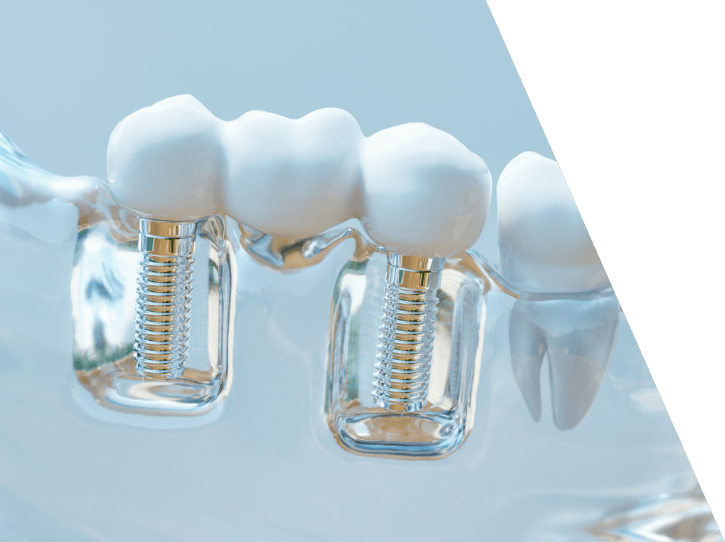 Model smile with dental implant supported fixed bridge