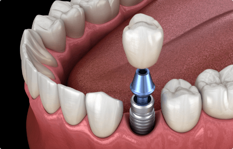 Animated smile during dental implant supported dental crown placement