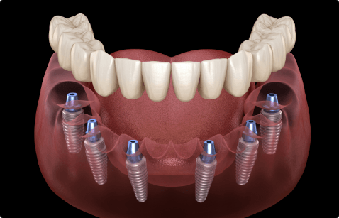 Animated smile during dental implant supported denture placement