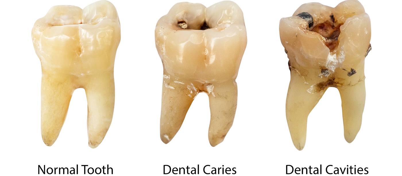 Images of tooth decay