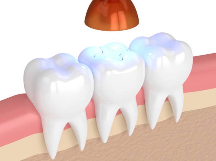 Dental light hardening white filling