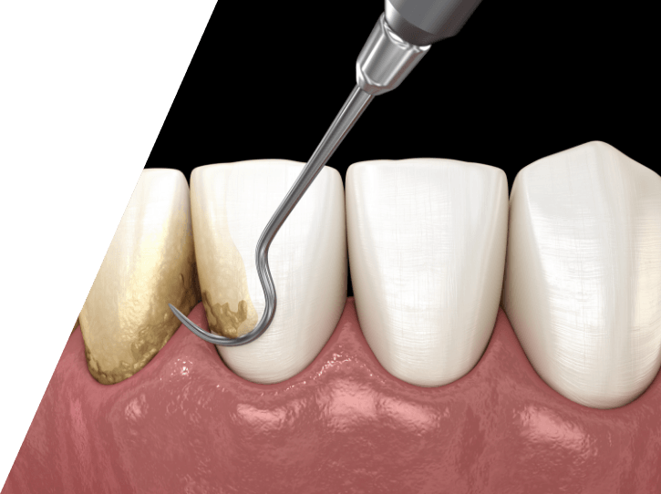 Animated smile during periodontal maintenance treatment