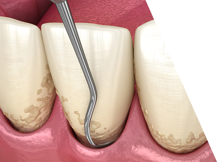 Animated smile during scaling and root planing treatment