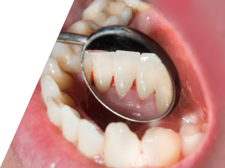 Closeup of smile during oral cancer screening