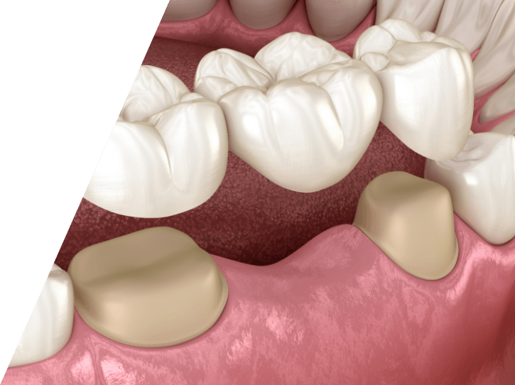 Animated smile during dental bridge placement