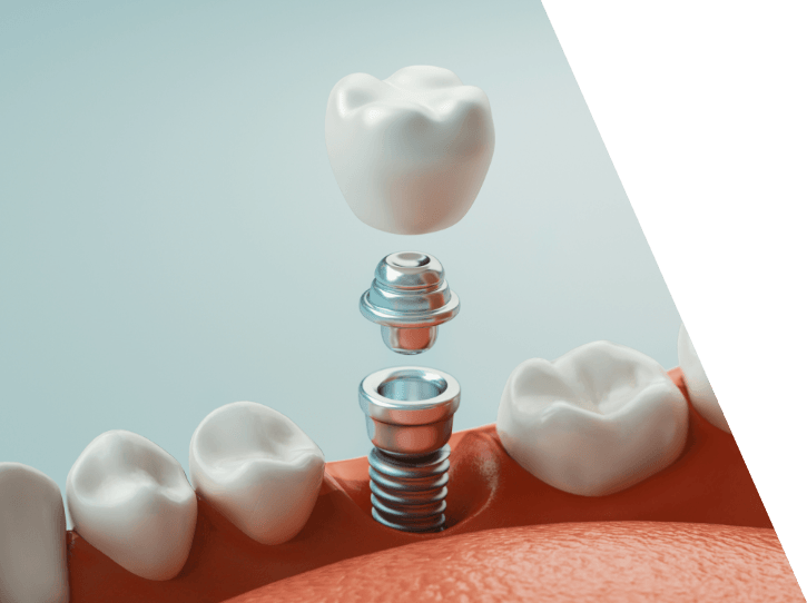 Animated smile during dental implant supported dental crown placement