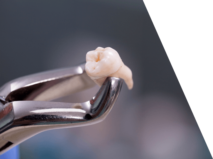 Metal clasp holding extracted tooth